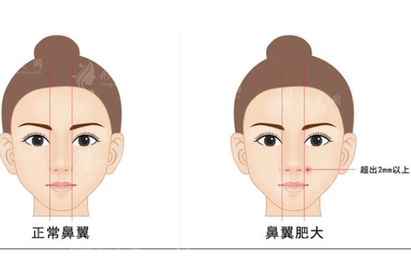 寬鼻矯正和鼻骨內(nèi)推一樣嗎？兩者有什么區(qū)別？