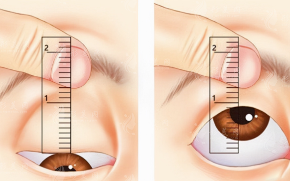 做上眼皮提拉手術(shù)恢復(fù)期是多久？有風(fēng)險(xiǎn)嗎？