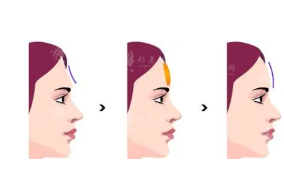 鼻翼縮小手術(shù)安全嗎？一起來探討鼻翼縮小手術(shù)的安全性