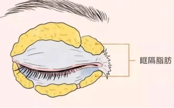 上眼皮抽脂怎么做？下面是上眼皮抽脂的詳細(xì)介紹