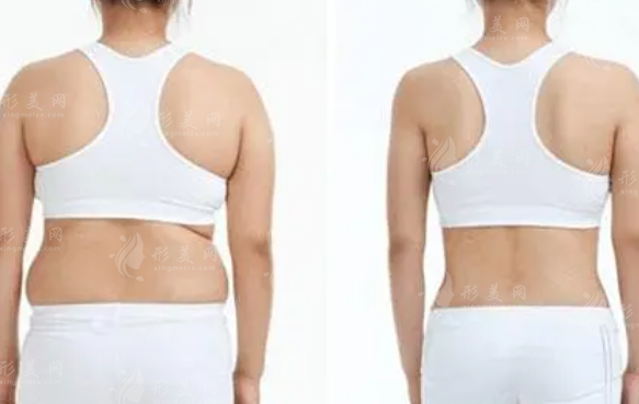 背部吸脂的常識有哪些？有風險和并發(fā)癥嗎？