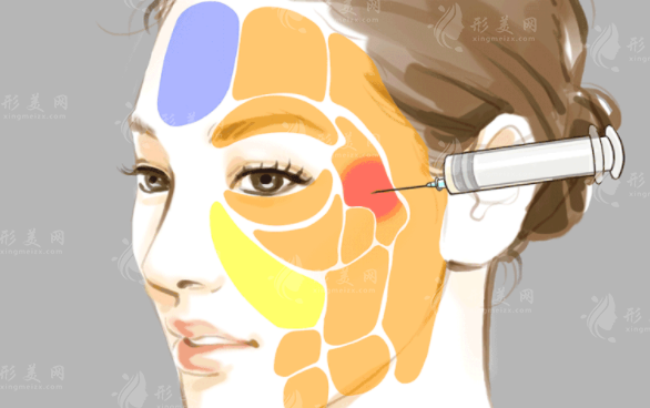 脂肪填充過量怎樣修復？手術方法一覽