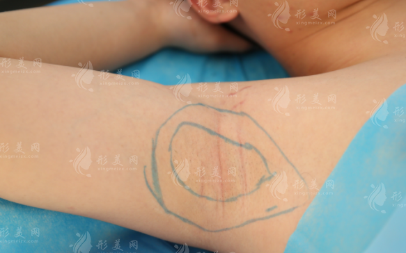 黃金微針治療腋臭效果好嗎？原理是什么？