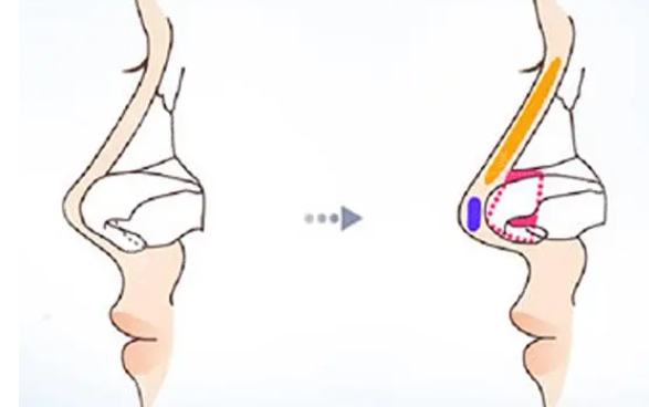 皮膚縫合法延長鼻小柱有哪些步驟呢？