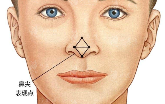 肥厚鼻尖矯正的技術(shù)方法都有什么呢？