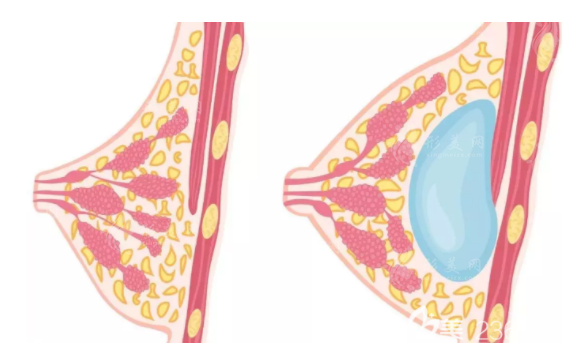 假體隆胸手術(shù)方法有哪些？乳暈切口好嗎？