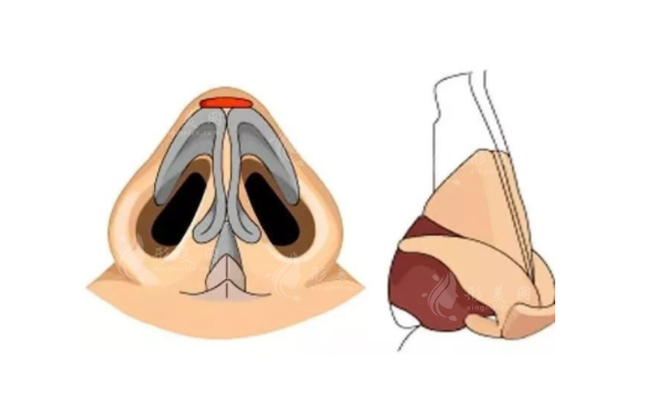 鼻小柱沒(méi)縫合好會(huì)出現(xiàn)什么問(wèn)題？
