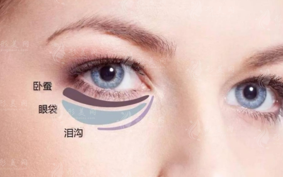 自體脂肪豐臥蠶容易移位嗎？可以采取哪些措施？