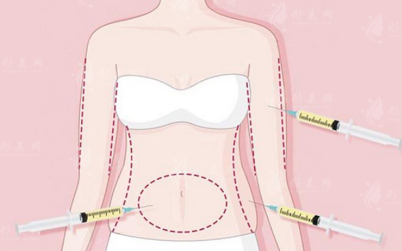 吸脂和抽脂是一樣的嗎？影響因素有什么？