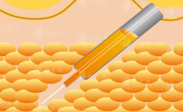 吸脂和抽脂是一樣的嗎？影響因素有什么？