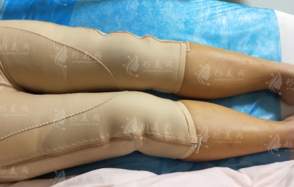 大腿吸脂一個(gè)月后還會(huì)再繼續(xù)瘦嗎？術(shù)后要注意什么？