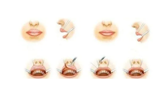 厚唇修薄手術(shù)原理和操作方法是什么？