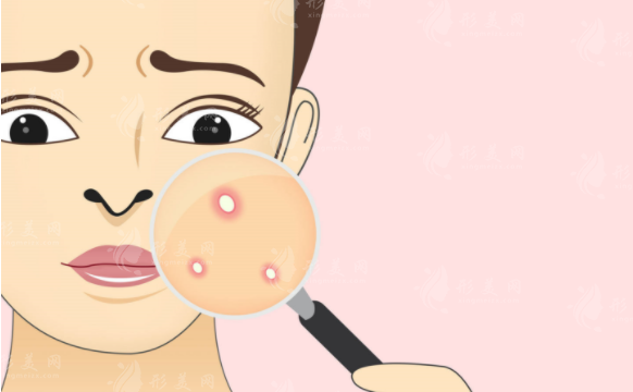 激光祛痘能徹底去掉嗎？原理是什么呢？