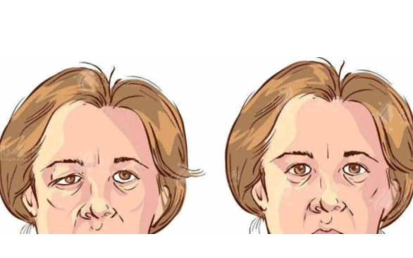 眼皮松弛怎么改善，是做雙眼皮好還是做切眉好？