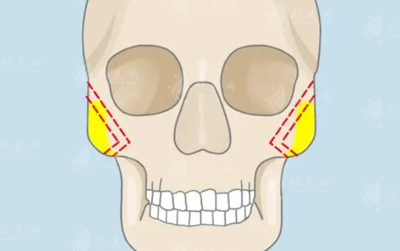 微創(chuàng)顴骨整形是什么？詳細(xì)科普分享