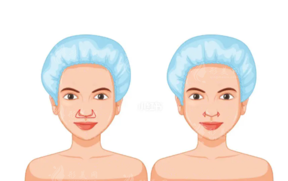 如何判斷膨體隆鼻感染初期的癥狀？教你少走彎路