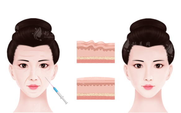 經(jīng)常打面部除皺針術(shù)后有什么副作用嗎？