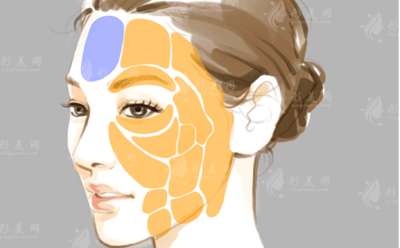 自體脂肪填充可以消除面部皺紋嗎？效果如何？