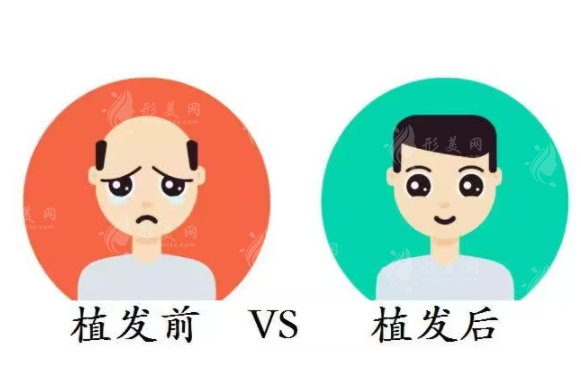 頭發(fā)種植原理是什么？下文為你介紹分享