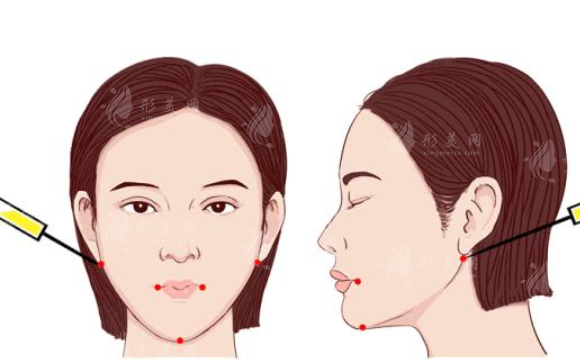 面部吸脂和去頰脂墊哪個好？該如何選擇？