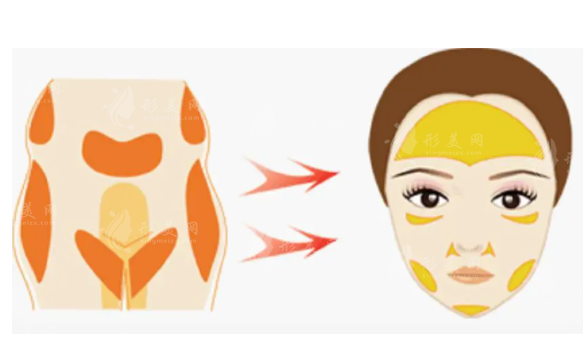 做了自體脂肪面部填充十年后會(huì)怎么樣呢？