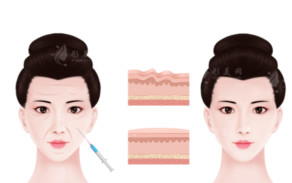 smas筋膜提升可以維持多久？有危害嗎？