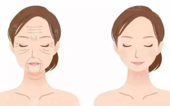 自體脂肪填充和線雕可以一起做嗎？適應(yīng)癥一覽