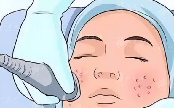 黃金微針VS微針，你分的清楚區(qū)別嗎？