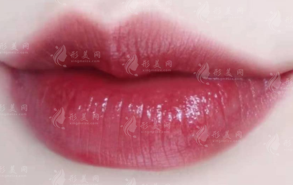 唇厚能做微笑唇嗎？做了微笑唇后感覺嘴巴變大了？