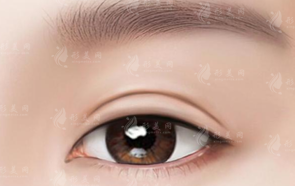 成都米蘭柏羽割雙眼皮怎么樣？醫(yī)生簡介+雙眼皮案例+價格表