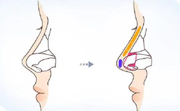 鼻小柱延長術(shù)的優(yōu)點和安全性是什么？