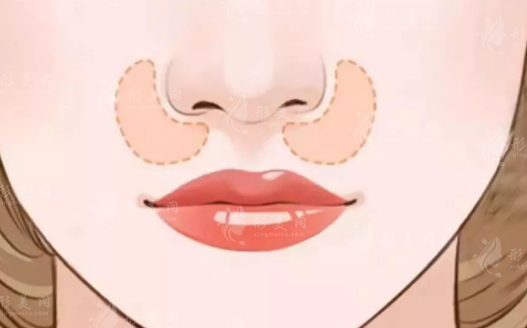 鼻基底填充手術(shù)好的材料是什么？