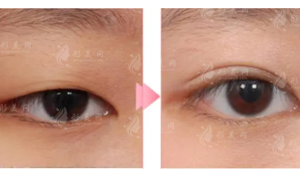 雙眼皮手術后留疤怎么辦？雙眼皮的類型如何選擇？