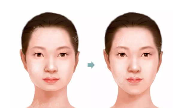 墊下巴選假體還是注射？哪種方法更加安全？