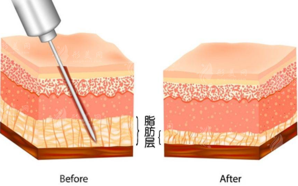 不是所有人的肥胖都適合吸脂，吸脂手術會不會反彈？