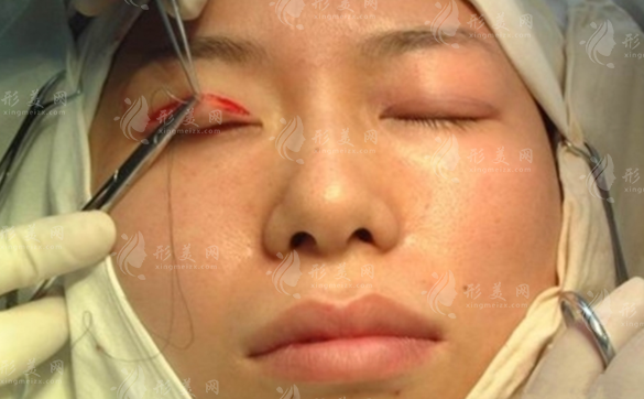 埋線雙眼皮優(yōu)勢有哪些？這幾類人千萬別做埋