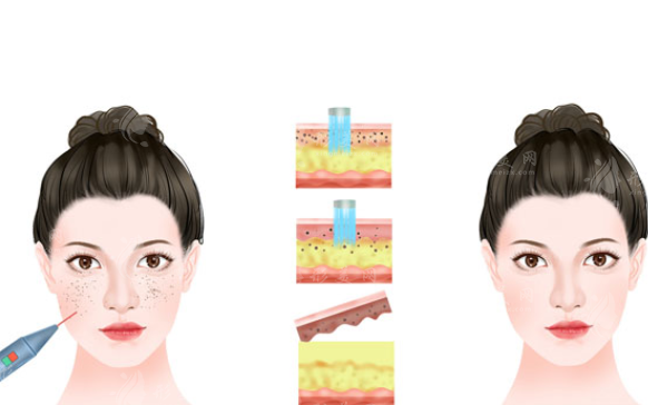 冬天激光祛斑幾天掉痂？激光祛斑后注意事項(xiàng)分享給大家！