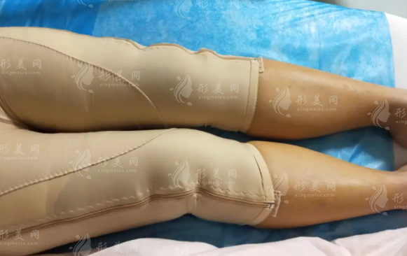 大腿吸脂要分多次進行嗎？大腿吸脂后多久可以正常外出？