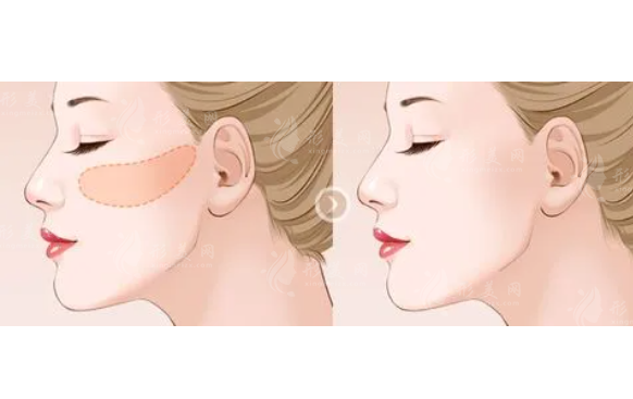 顴骨縮小手術(shù)需要多少錢？有風(fēng)險嗎？