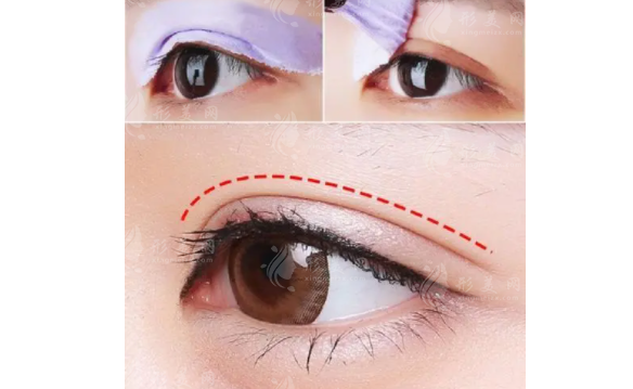 雙眼皮手術(shù)中“埋線”埋的是什么線？埋線過(guò)程一覽
