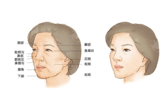 深圳藝星整形脂肪填充怎么樣？醫(yī)生名單一覽、案例分享、附價(jià)格表