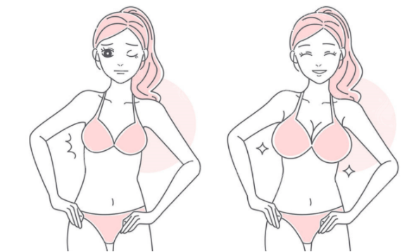 哪種隆胸手術(shù)方式適合你？豐胸材質(zhì)對(duì)比一覽！