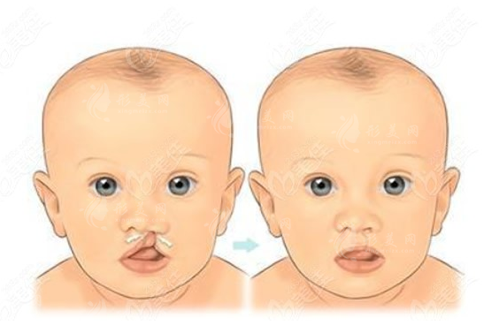 上海九院做唇腭裂手術(shù)優(yōu)勢