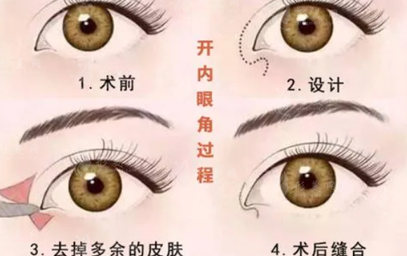 開眼角和割雙眼皮有什么區(qū)別呢？開眼角術(shù)后需要注意哪些呢？