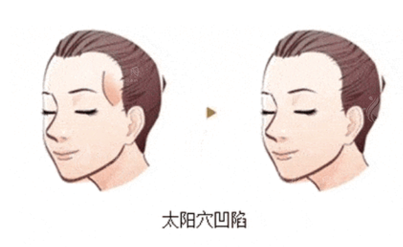 太陽穴凹陷填充方法有哪些？各自優(yōu)勢(shì)有哪些？