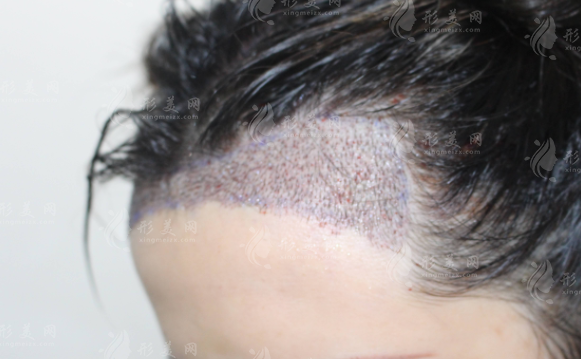 植發(fā)后復(fù)脫是怎么回事？還能解決嗎？