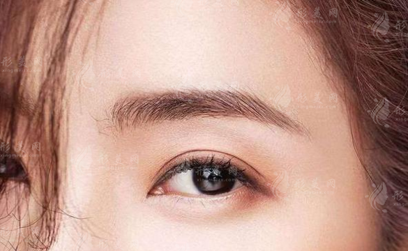 假體隆眉弓如何操作的？眉弓適用于太近或太寬的眉眼間距嗎？