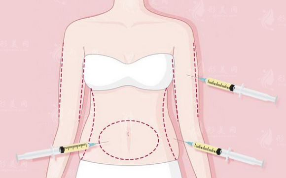 吸脂手術(shù)的抽取量是多少？塑身衣多長時間能看到效果？