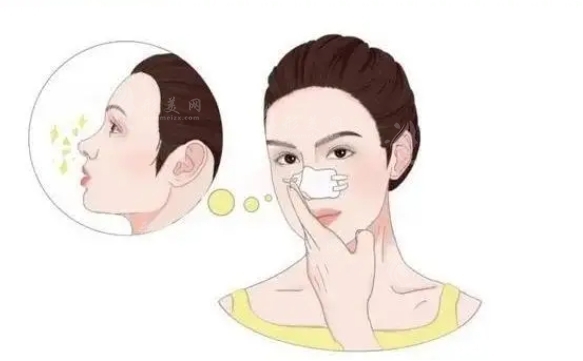 縮小鼻翼鼻頭手術(shù)多少錢？風(fēng)險(xiǎn)大嗎？