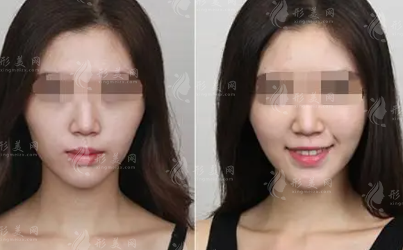 哪些人適合豐蘋果?。坑貌Ｄ蛩崽畛浜眠€是自體脂肪填充果好？